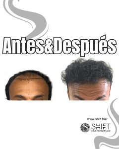 Antes Después de un trasplante de cabello afro en Turquía en SHIFT Hair en Estambul 12 3