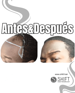 Antes Después de un trasplante de cabello afro en Turquía en SHIFT Hair en Estambul 14 3