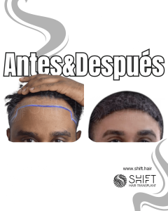 Antes Después de un trasplante de cabello afro en Turquía en SHIFT Hair en Estambul 16 3
