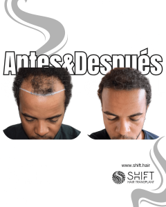 Antes Después de un trasplante de cabello afro en Turquía en SHIFT Hair en Estambul 19 3