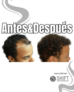 Antes Después de un trasplante de cabello afro en Turquía en SHIFT Hair en Estambul 20 3