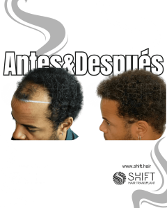 Antes Después de un trasplante de cabello afro en Turquía en SHIFT Hair en Estambul 21 3