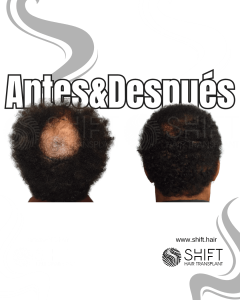 Antes Después de un trasplante de cabello afro en Turquía en SHIFT Hair en Estambul 22 3