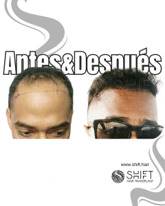 Antes Después de un trasplante de cabello afro en Turquía en SHIFT Hair en Estambul 26 3