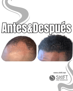 Antes Después de un trasplante de cabello afro en Turquía en SHIFT Hair en Estambul 30 3