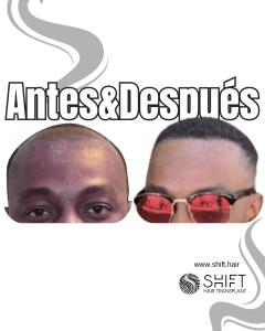 Antes Después de un trasplante de cabello afro en Turquía en SHIFT Hair en Estambul 31 3