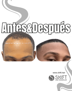Antes Después de un trasplante de cabello afro en Turquía en SHIFT Hair en Estambul 33 3