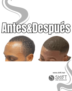 Antes Después de un trasplante de cabello afro en Turquía en SHIFT Hair en Estambul 34 3