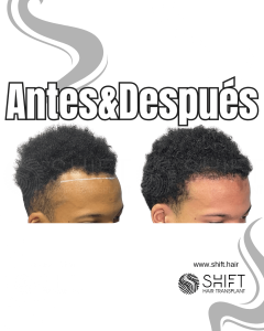 Antes Después de un trasplante de cabello afro en Turquía en SHIFT Hair en Estambul 35 3