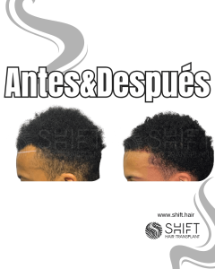 Antes Después de un trasplante de cabello afro en Turquía en SHIFT Hair en Estambul 38 3