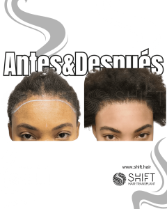 Antes Después de un trasplante de cabello afro para mujeres en Turquía en SHIFT Hair en Estambul 01 3