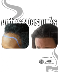 Antes Después de un trasplante de cabello afro para mujeres en Turquía en SHIFT Hair en Estambul 05 3
