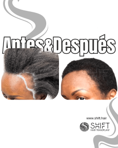 Antes Después de un trasplante de cabello afro para mujeres en Turquía en SHIFT Hair en Estambul 06 3