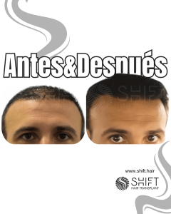 Antes Después de un trasplante de cabello de patrón femenino en Turquía en SHIFT Hair en Estambul 02 3
