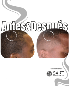 Antes Después de un trasplante de cabello en una pequeña área en Turquía en SHIFT Hair en Estambul 02 3