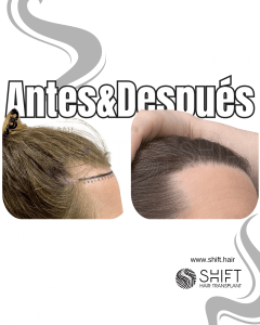 Antes Después de un trasplante de cabello para mujeres en Turquía en SHIFT Hair en Estambul 01 3