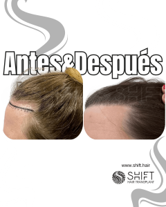 Antes Después de un trasplante de cabello para mujeres en Turquía en SHIFT Hair en Estambul 02 3