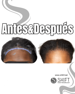 Antes Después de un trasplante de cabello para mujeres en Turquía en SHIFT Hair en Estambul 05 3