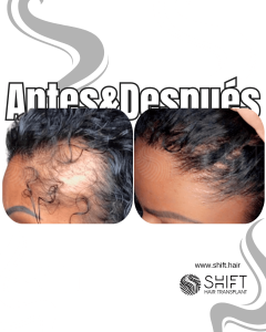 Antes Después de un trasplante de cabello para mujeres en Turquía en SHIFT Hair en Estambul 06 3