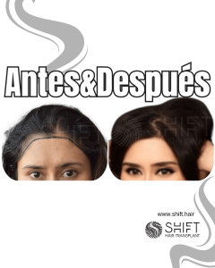 Antes Después de un trasplante de cabello para mujeres en Turquía en SHIFT Hair en Estambul 10 3
