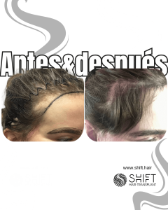 Antes Después de un trasplante de cabello para mujeres en Turquía en SHIFT Hair en Estambul 12 3