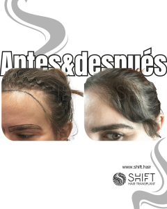 Antes Después de un trasplante de cabello para mujeres en Turquía en SHIFT Hair en Estambul 13 3