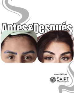 Antes Después de un trasplante de cejas en Turquía en SHIFT Hair en Estambul 01 3