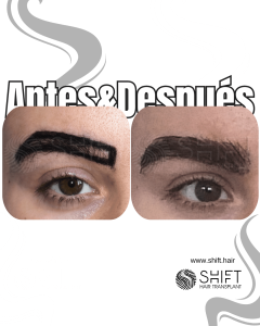Antes Después de un trasplante de cejas en Turquía en SHIFT Hair en Estambul 02 3