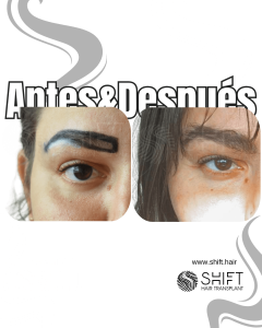 Antes Después de un trasplante de cejas en Turquía en SHIFT Hair en Estambul 04 3