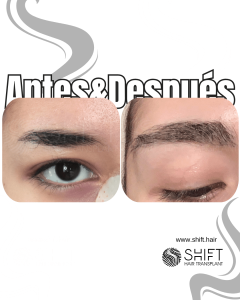 Antes Después de un trasplante de cejas en Turquía en SHIFT Hair en Estambul 06 3