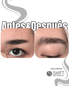 Antes Después de un trasplante de cejas en Turquía en SHIFT Hair en Estambul 07 3