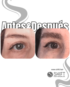 Antes Después de un trasplante de cejas en Turquía en SHIFT Hair en Estambul 08 3