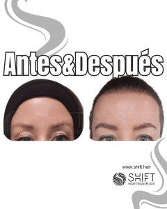 Antes Después de un trasplante de cejas en Turquía en SHIFT Hair en Estambul 10 3
