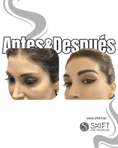 Antes Después de un trasplante de cejas en Turquía en SHIFT Hair en Estambul 12 3
