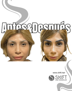Antes Después de un trasplante de cejas en Turquía en SHIFT Hair en Estambul 16 3
