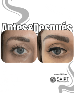 Antes Después de un trasplante de cejas en Turquía en SHIFT Hair en Estambul 17 3