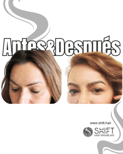 Antes Después de un trasplante de cejas en Turquía en SHIFT Hair en Estambul 21 3