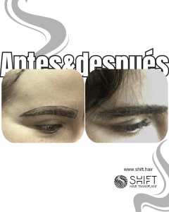 Antes Después de un trasplante de cejas en Turquía en SHIFT Hair en Estambul 23 3