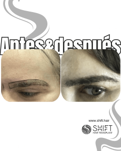 Antes Después de un trasplante de cejas en Turquía en SHIFT Hair en Estambul 24 3