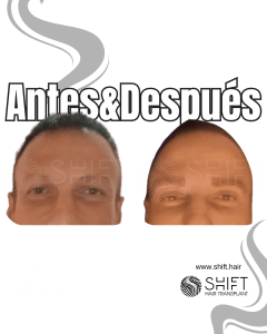 Antes Después de un trasplante de cejas para hombres en Turquía en SHIFT Hair en Estambul 02 3