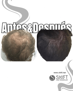 Antes y después de un PRP capilar en Turquía en SHIFT Hair en Estambul 01 3