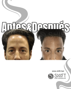 Antes y después de un trasplante capilar para la calvicie de Norwood 1 en Turquía en SHIFT Hair en Estambul 01 3