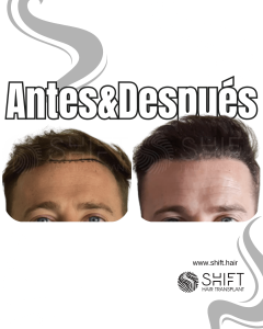 Antes y después de un trasplante capilar para la calvicie de Norwood 1 en Turquía en SHIFT Hair en Estambul 02 3
