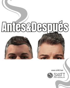 Antes y después de un trasplante capilar para la calvicie de Norwood 1 en Turquía en SHIFT Hair en Estambul 03 3