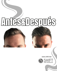 Antes y después de un trasplante capilar para la calvicie de Norwood 2 en Turquía en SHIFT Hair en Estambul 02 3