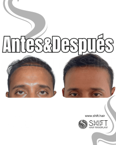 Antes y después de un trasplante capilar para la calvicie de Norwood 2 en Turquía en SHIFT Hair en Estambul 03 3