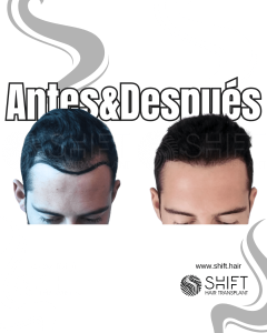 Antes y después de un trasplante capilar para la calvicie de Norwood 2 en Turquía en SHIFT Hair en Estambul 05 3