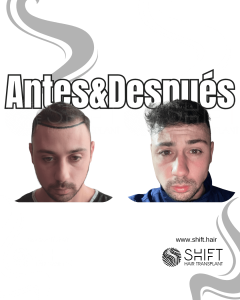 Antes y después de un trasplante capilar para la calvicie de Norwood 2 en Turquía en SHIFT Hair en Estambul 06 3