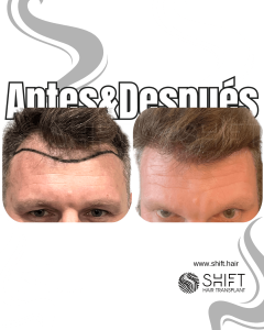 Antes y después de un trasplante capilar para la calvicie de Norwood 2 en Turquía en SHIFT Hair en Estambul 08 3