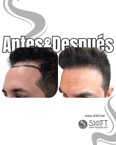 Antes y después de un trasplante capilar para la calvicie de Norwood 2 en Turquía en SHIFT Hair en Estambul 10 3